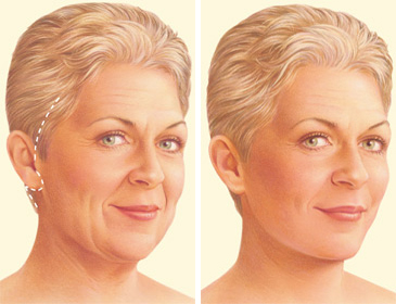 facelift surgery traditional incision