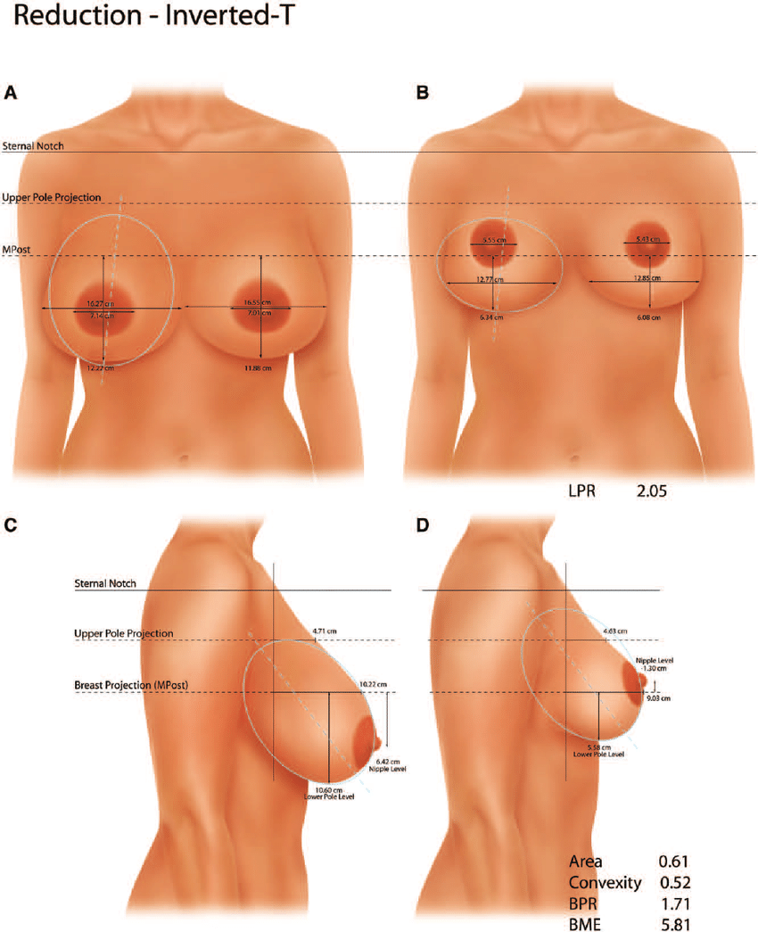 Breast-shape-before-A-C-and-after-B-D-inverted-T-breast-reduction-Breast.png