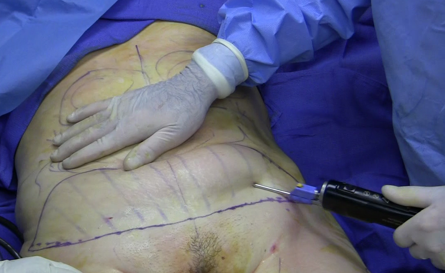 Fat_removal_using_cannula_during_tumescent_liposuction.jpg