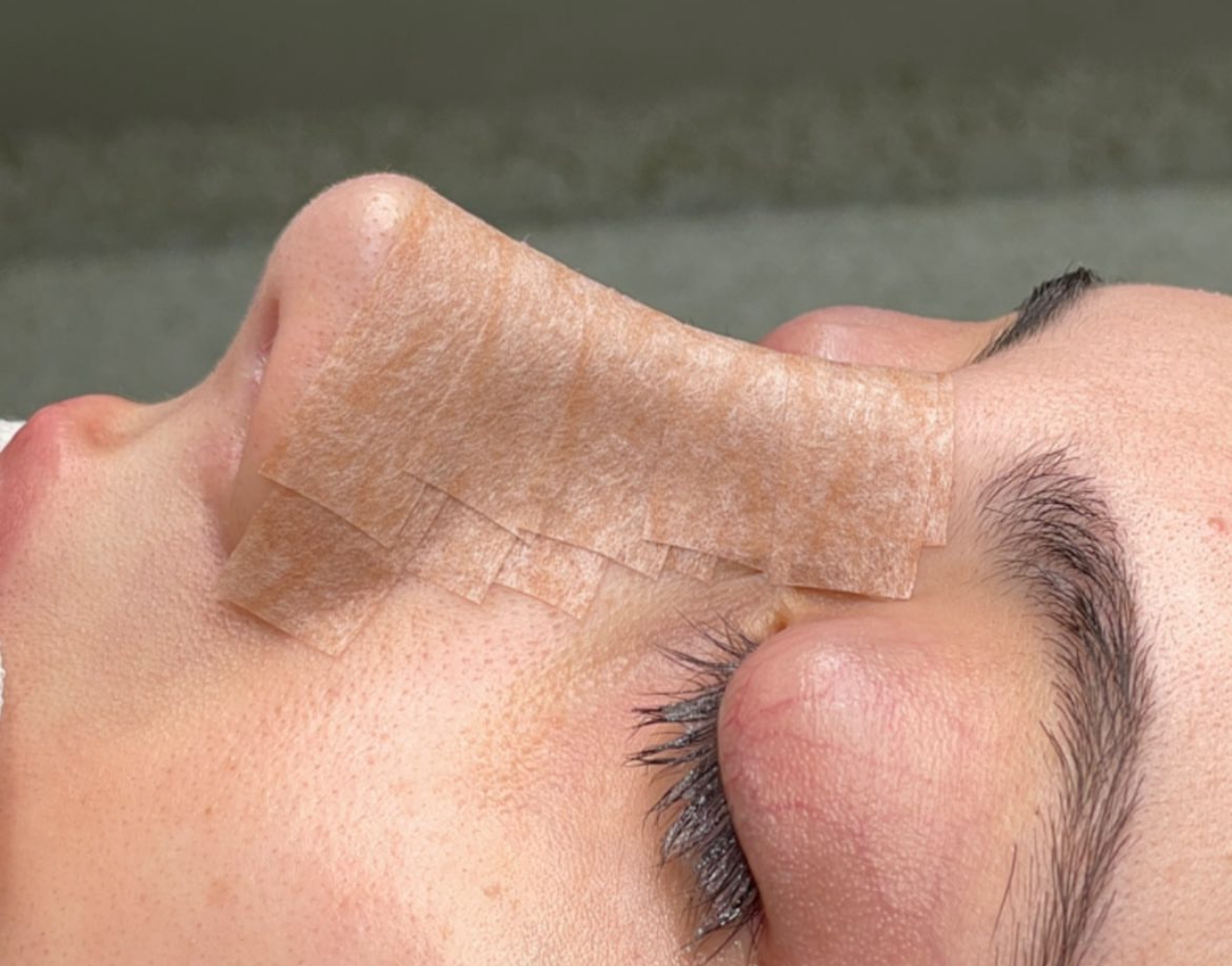 Qapali rinoplastika