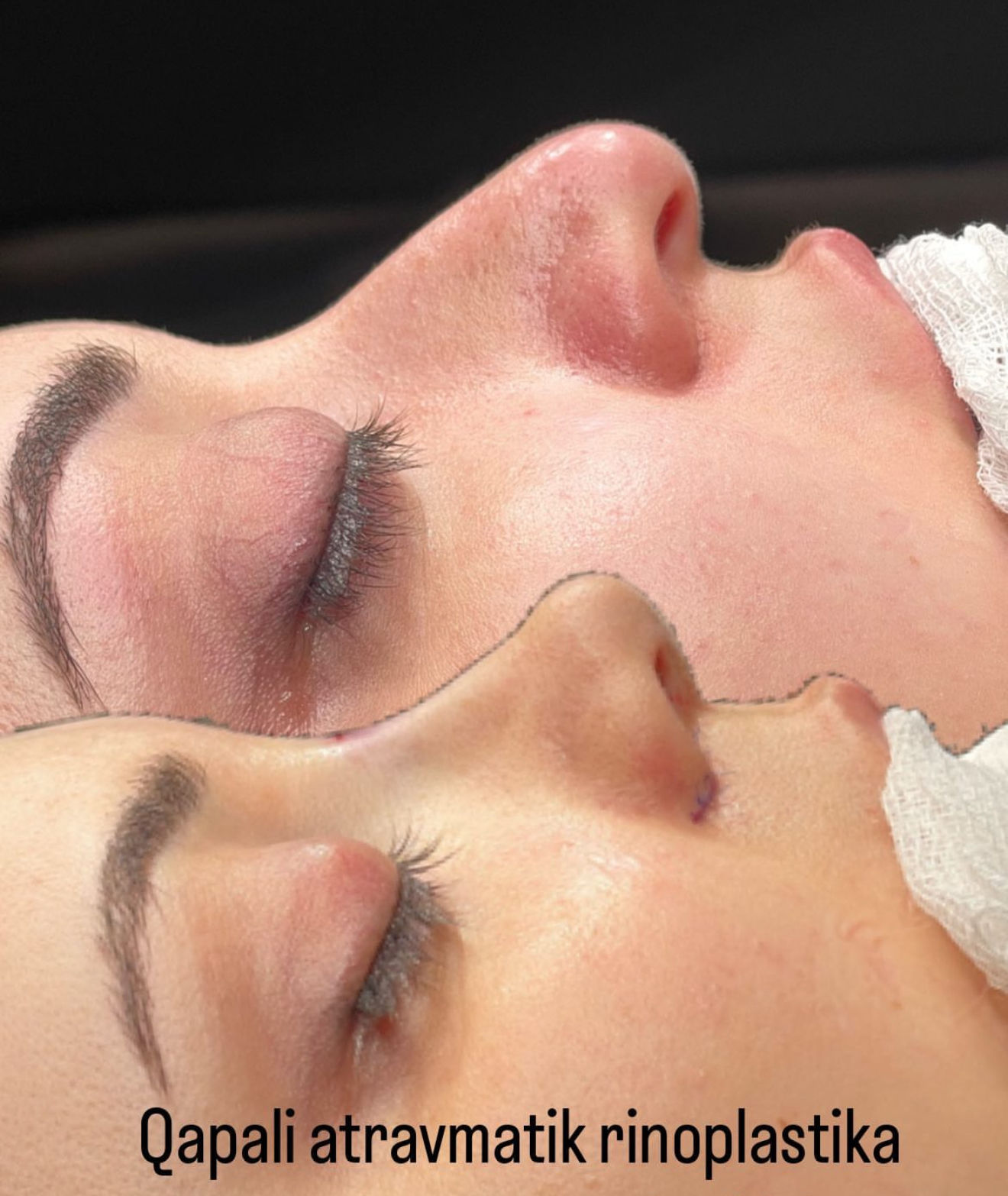 Qapali Rinoplastika Dr Alif