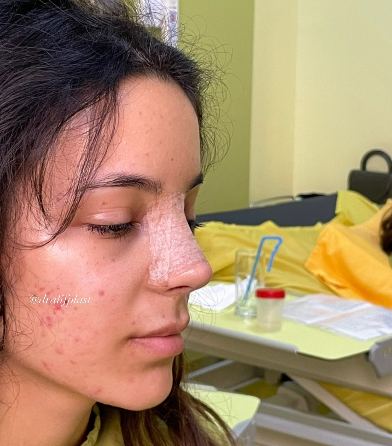 Qapali rinoplastikadan 2 hefte sonra