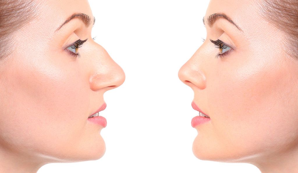 rhinoplasty dr panossian los angeles 1