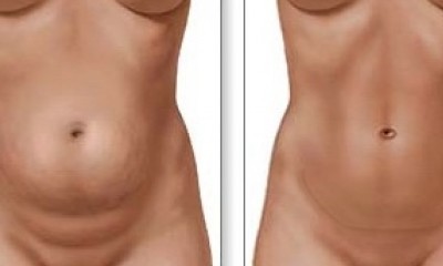 abdominoplastika-hirurgija-dr-djokovic-centar-za-kile.jpg