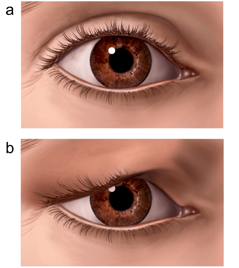 blepharoplasty-illustration-9c8eac.png