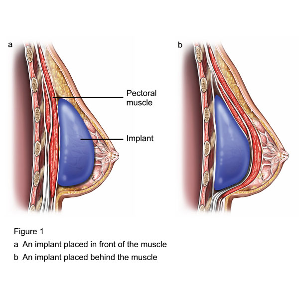 breast-augmentation.jpg