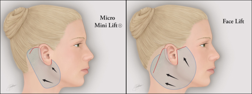 micro-mini-facelift-richmond.jpg