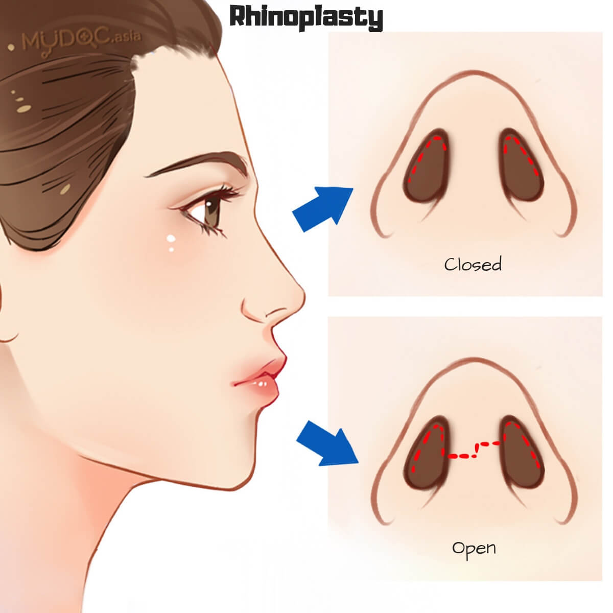 rhinoplasty-mydoctiny.jpg